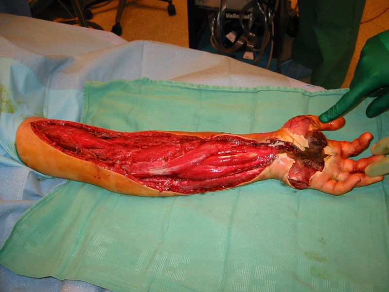Rattlesnake Bite Victim