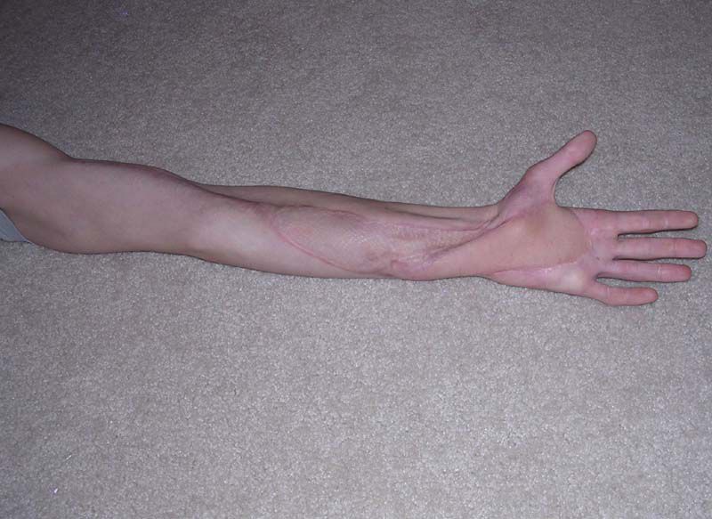After twenty months and thirteen surgeries, the snakebite victim has recovered mobility and about 80% of the strength in his affected arm and hand