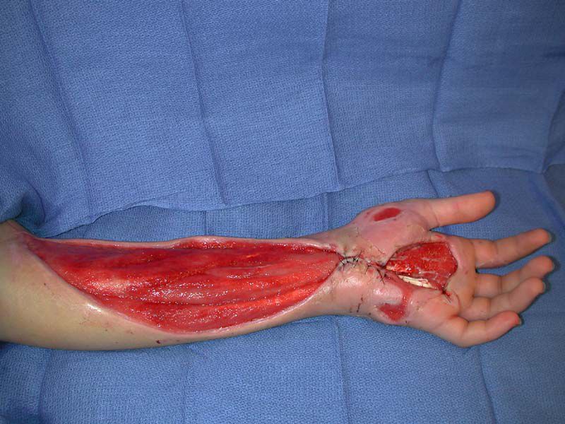 The healing process is a slow one, but gradually, the injury began to improve.
