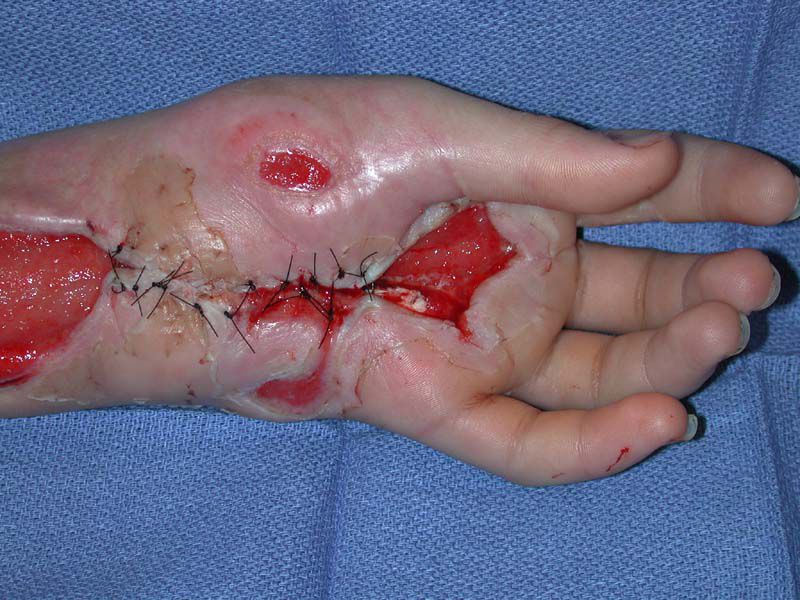 Stitches and staples were used to hold the edges of the wound in place, and a surgical mesh covered the open muscles.