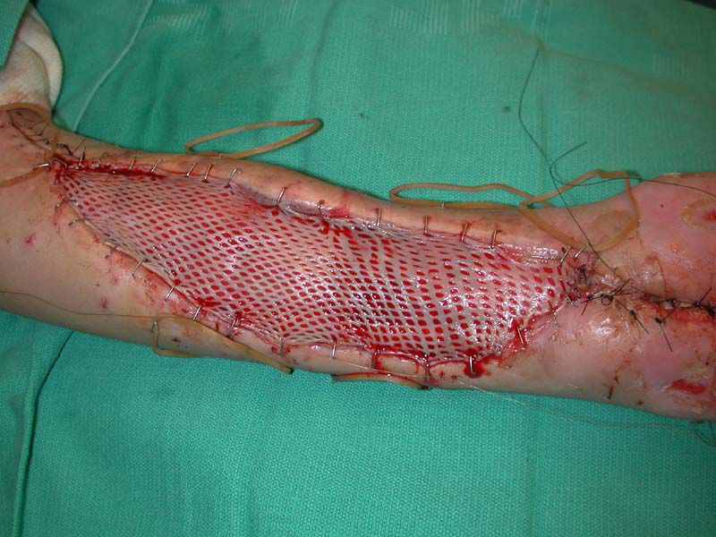 A skin graft, using tissue removed from the victim's leg, was used to cover the opening in his arm.