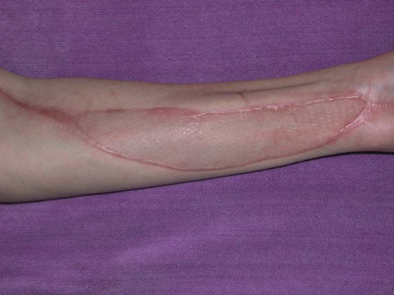 Follow up surgeries included a vascular flap procedure using skin and muscle from the victim's back, connecting the flap's blood vessels to the ones in his arm using microsurgery before stitching the flap to his arm.